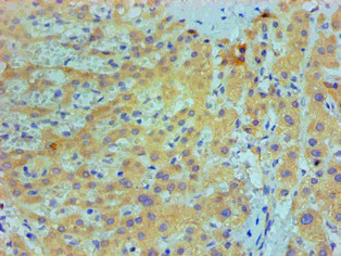 IL1F10 Antibody - Immunohistochemical of paraffin-embedded Human live cancer tissue using IL1F10 Monoclonal Antibody at dilution of 1:200.