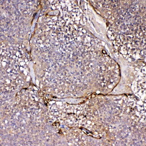 IL1F10 Antibody - IHC analysis of IL1F10 using anti-IL1F10 antibody. IL1F10 was detected in paraffin-embedded section of human tonsil tissue . Heat mediated antigen retrieval was performed in citrate buffer (pH6, epitope retrieval solution) for 20 mins. The tissue section was blocked with 10% goat serum. The tissue section was then incubated with 1µg/ml rabbit anti-IL1F10 Antibody overnight at 4°C. Biotinylated goat anti-rabbit IgG was used as secondary antibody and incubated for 30 minutes at 37°C. The tissue section was developed using Strepavidin-Biotin-Complex (SABC) with DAB as the chromogen.