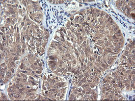 IL1F9 Antibody - IHC of paraffin-embedded Adenocarcinoma of Human ovary tissue using anti-IL1F9 mouse monoclonal antibody.