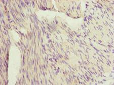 IL1F9 Antibody - Immunohistochemistry of paraffin-embedded human bladder cancer at dilution of 1:100