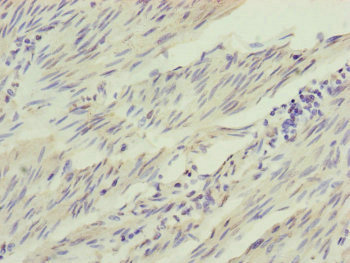 IL1F9 Antibody - Immunohistochemistry of paraffin-embedded human bladder cancer at dilution of 1:100