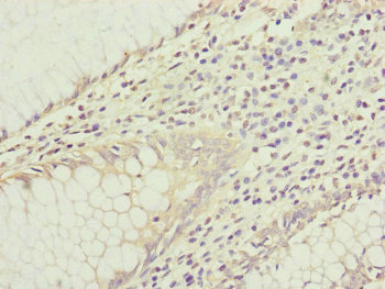 IL1F9 Antibody - Immunohistochemistry of paraffin-embedded human colon cancer at dilution of 1:100