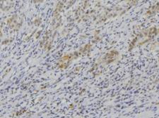 IL1F9 Antibody - 1:100 staining human lung carcinoma tissue by IHC-P. The sample was formaldehyde fixed and a heat mediated antigen retrieval step in citrate buffer was performed. The sample was then blocked and incubated with the antibody for 1.5 hours at 22°C. An HRP conjugated goat anti-rabbit antibody was used as the secondary.