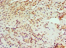 IL1RAP Antibody - Immunohistochemistry of paraffin-embedded human breast cancer using antibody at 1:100 dilution.