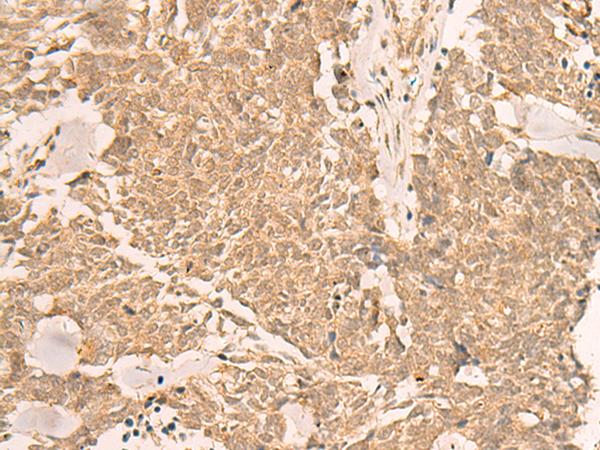 IL1RAPL2 Antibody - Immunohistochemistry of paraffin-embedded Human lung cancer tissue  using IL1RAPL2 Polyclonal Antibody at dilution of 1:25(×200)