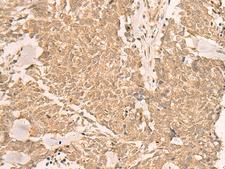 IL1RAPL2 Antibody - Immunohistochemistry of paraffin-embedded Human lung cancer tissue  using IL1RAPL2 Polyclonal Antibody at dilution of 1:25(×200)