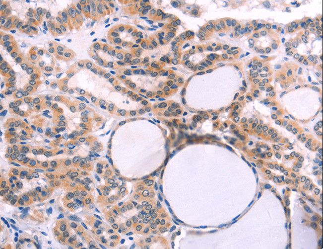 IL1RL1 Antibody - Immunohistochemistry of paraffin-embedded Human thyroid cancer using IL1RL1 Polyclonal Antibody at dilution of 1:40.