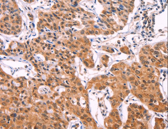IL1RL1 Antibody - Immunohistochemistry of paraffin-embedded Human lung cancer using IL1RL1 Polyclonal Antibody at dilution of 1:70.