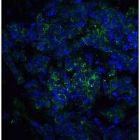 IL1RL1 Antibody - Immunofluorescence of ST2 in human lung cancer tissue with ST2 antibody at 5 µg/ml.Green: ST2 Antibody  Blue: DAPI staining