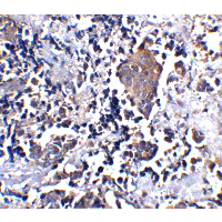 IL1RL1 Antibody - Immunohistochemistry of ST2 in human lung cancer tissue with ST2 antibody at 5 µg/ml.