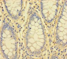 IL1RL2 Antibody - Immunohistochemistry of paraffin-embedded human colon cancer using IL1RL2 Antibody at dilution of 1:100