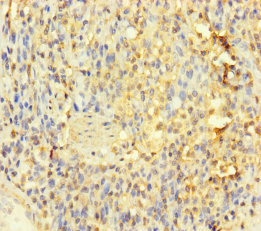 IL1RL2 Antibody - Immunohistochemistry of paraffin-embedded human gastric cancer using IL1RL2 Antibody at dilution of 1:100
