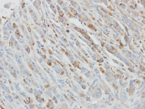 IL1RN Antibody - IHC of paraffin-embedded PC3 xenograft using IL1 Receptor antagonist antibody at 1:500 dilution.