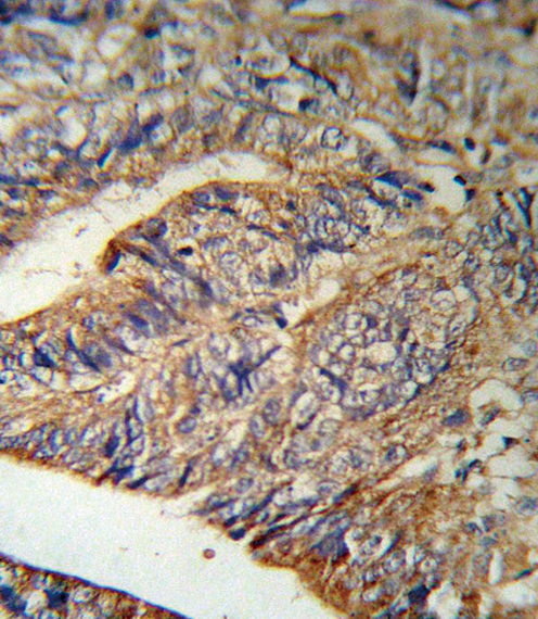 IL1RN Antibody - IL1RN Antibody (RB18901) IHC of formalin-fixed and paraffin-embedded human Colon carcinoma followed by peroxidase-conjugated secondary antibody and DAB staining.