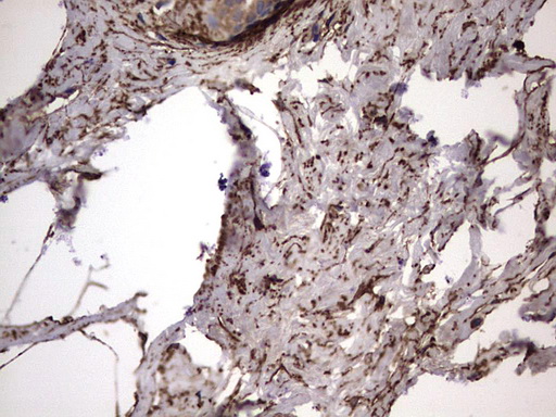 IL1RN Antibody - IHC of paraffin-embedded Human breast tissue using anti-IL1RN mouse monoclonal antibody. (Heat-induced epitope retrieval by 1 mM EDTA in 10mM Tris, pH8.5, 120°C for 3min).