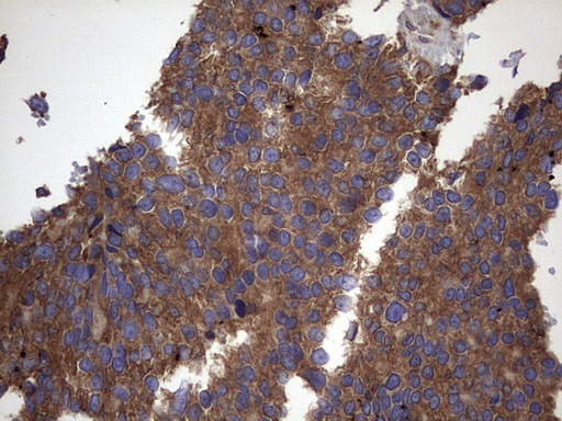 IL1RN Antibody - IHC of paraffin-embedded Adenocarcinoma of Human breast tissue using anti-IL1RN mouse monoclonal antibody. (Heat-induced epitope retrieval by 1 mM EDTA in 10mM Tris, pH8.5, 120°C for 3min).