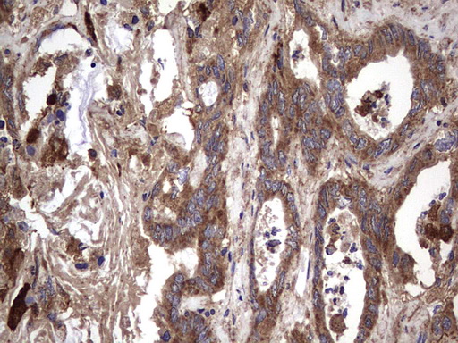 IL1RN Antibody - IHC of paraffin-embedded Adenocarcinoma of Human colon tissue using anti-IL1RN mouse monoclonal antibody. (Heat-induced epitope retrieval by 1 mM EDTA in 10mM Tris, pH8.5, 120°C for 3min).