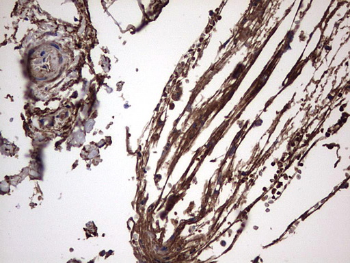 IL1RN Antibody - IHC of paraffin-embedded Carcinoma of Human kidney tissue using anti-IL1RN mouse monoclonal antibody. (Heat-induced epitope retrieval by 1 mM EDTA in 10mM Tris, pH8.5, 120°C for 3min).