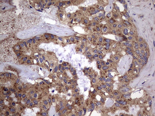 IL1RN Antibody - IHC of paraffin-embedded Carcinoma of Human liver tissue using anti-IL1RN mouse monoclonal antibody. (Heat-induced epitope retrieval by 1 mM EDTA in 10mM Tris, pH8.5, 120°C for 3min).