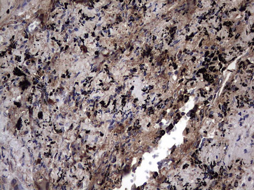IL1RN Antibody - IHC of paraffin-embedded Carcinoma of Human lung tissue using anti-IL1RN mouse monoclonal antibody. (Heat-induced epitope retrieval by 1 mM EDTA in 10mM Tris, pH8.5, 120°C for 3min).