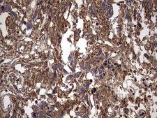 IL1RN Antibody - IHC of paraffin-embedded Adenocarcinoma of Human ovary tissue using anti-IL1RN mouse monoclonal antibody. (Heat-induced epitope retrieval by 1 mM EDTA in 10mM Tris, pH8.5, 120°C for 3min).