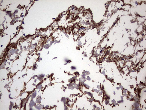 IL1RN Antibody - IHC of paraffin-embedded Human thyroid tissue using anti-IL1RN mouse monoclonal antibody. (Heat-induced epitope retrieval by 1 mM EDTA in 10mM Tris, pH8.5, 120°C for 3min).