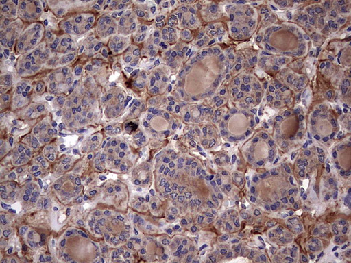 IL1RN Antibody - IHC of paraffin-embedded Carcinoma of Human thyroid tissue using anti-IL1RN mouse monoclonal antibody. (Heat-induced epitope retrieval by 1 mM EDTA in 10mM Tris, pH8.5, 120°C for 3min).