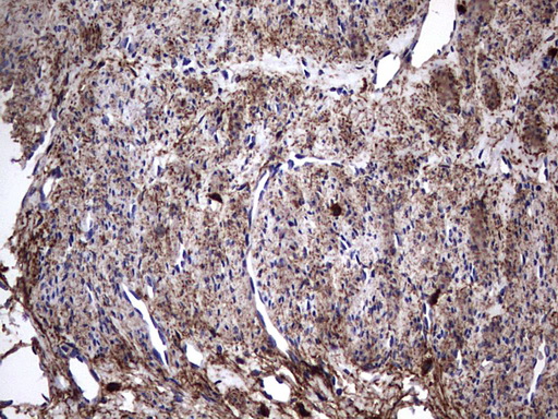IL1RN Antibody - IHC of paraffin-embedded Adenocarcinoma of Human endometrium tissue using anti-IL1RN mouse monoclonal antibody. (Heat-induced epitope retrieval by 1 mM EDTA in 10mM Tris, pH8.5, 120°C for 3min).
