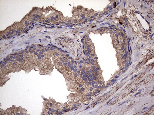 IL1RN Antibody - IHC of paraffin-embedded Carcinoma of Human prostate tissue using anti-IL1RN mouse monoclonal antibody. (Heat-induced epitope retrieval by 1 mM EDTA in 10mM Tris, pH8.5, 120°C for 3min).