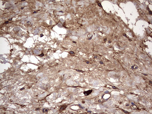 IL1RN Antibody - IHC of paraffin-embedded Human bladder tissue using anti-IL1RN mouse monoclonal antibody. (Heat-induced epitope retrieval by 1 mM EDTA in 10mM Tris, pH8.5, 120°C for 3min).