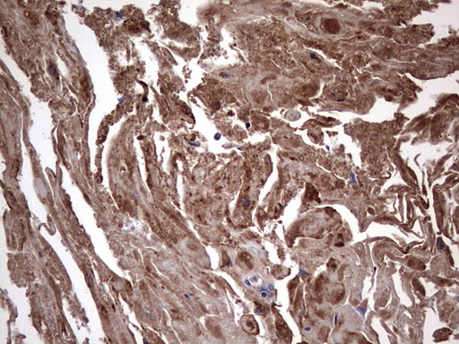 IL1RN Antibody - IHC of paraffin-embedded Carcinoma of Human bladder tissue using anti-IL1RN mouse monoclonal antibody. (Heat-induced epitope retrieval by 1 mM EDTA in 10mM Tris, pH8.5, 120°C for 3min).