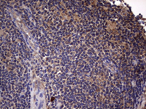 IL1RN Antibody - IHC of paraffin-embedded Human lymphoma tissue using anti-IL1RN mouse monoclonal antibody. (Heat-induced epitope retrieval by 1 mM EDTA in 10mM Tris, pH8.5, 120°C for 3min).