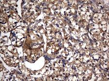IL1RN Antibody - IHC of paraffin-embedded Carcinoma of Human kidney tissue using anti-IL1RN mouse monoclonal antibody. (Heat-induced epitope retrieval by 10mM citric buffer, pH6.0, 120°C for 3min).