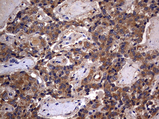 IL1RN Antibody - IHC of paraffin-embedded Carcinoma of Human pancreas tissue using anti-IL1RN mouse monoclonal antibody. (Heat-induced epitope retrieval by 10mM citric buffer, pH6.0, 120°C for 3min).