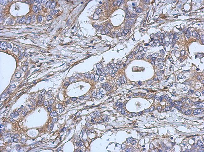 IL2 Antibody - IHC of paraffin-embedded Gastric ca, using IL2 antibody at 1:500 dilution.