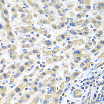 IL2 Antibody - Immunohistochemistry of paraffin-embedded human liver cancer using IL2 antibodyat dilution of 1:100 (40x lens).