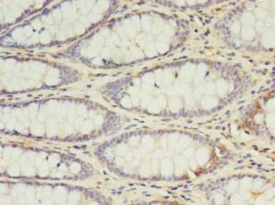 IL2 Antibody - Immunohistochemistry of paraffin-embedded human colon cancer using antibody at 1:100 dilution.