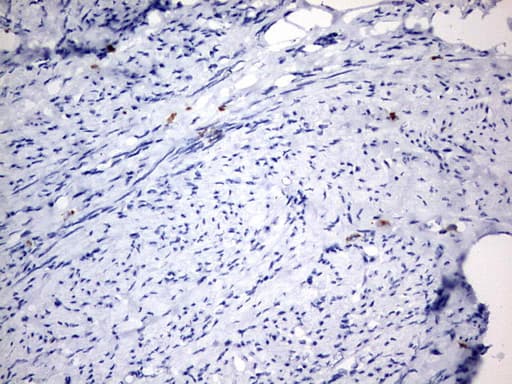 IL20 Antibody - IHC of paraffin-embedded Adenocarcinoma of Human endometrium tissue using anti-IL20 mouse monoclonal antibody. (Heat-induced epitope retrieval by 10mM citric buffer, pH6.0, 120°C for 3min).