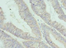 IL20 Antibody - Immunohistochemistry of paraffin-embedded human endometrial cancer at dilution 1:100