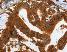 IL20RA Antibody - Immunohistochemistry of paraffin-embedded Human lung cancer using IL20RA Polyclonal Antibody at dilution of 1:35.