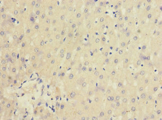 IL20RA Antibody - Immunohistochemistry of paraffin-embedded human liver cancer at dilution 1:100