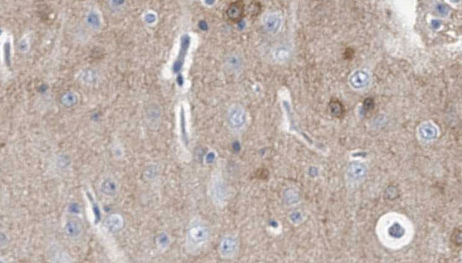 IL20RA Antibody - 1:100 staining human brain carcinoma tissue by IHC-P. The sample was formaldehyde fixed and a heat mediated antigen retrieval step in citrate buffer was performed. The sample was then blocked and incubated with the antibody for 1.5 hours at 22°C. An HRP conjugated goat anti-rabbit antibody was used as the secondary.