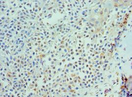 IL21 Antibody - Immunohistochemistry of paraffin-embedded human breast cancer using antibody at 1:100 dilution.