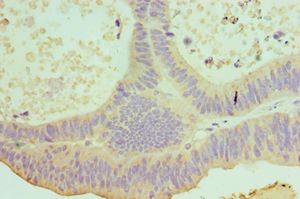 IL22 Antibody - Immunohistochemistry of paraffin-embedded human colon cancer using antibody at 1:100 dilution.