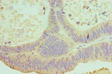 IL22 Antibody - Immunohistochemistry of paraffin-embedded human colon cancer using antibody at 1:100 dilution.