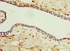 IL22RA1 / IL22R Antibody - Immunohistochemistry of paraffin-embedded human breast cancer using antibody at 1:100 dilution.