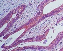 IL23R Antibody - Immunohistochemistry-Paraffin: IL23 Receptor Antibody (15N6C6) [Azide Free] - Analysis of IL-23 receptor in human colon tissue using IL-23 receptor antibody at 5 ug/ml. This image was taken for the unmodified form of this product. Other forms have not been tested.
