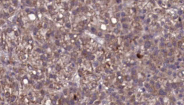 IL23R Antibody - 1:100 staining human liver carcinoma tissues by IHC-P. The sample was formaldehyde fixed and a heat mediated antigen retrieval step in citrate buffer was performed. The sample was then blocked and incubated with the antibody for 1.5 hours at 22°C. An HRP conjugated goat anti-rabbit antibody was used as the secondary.