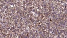 IL23R Antibody - 1:100 staining human liver carcinoma tissues by IHC-P. The sample was formaldehyde fixed and a heat mediated antigen retrieval step in citrate buffer was performed. The sample was then blocked and incubated with the antibody for 1.5 hours at 22°C. An HRP conjugated goat anti-rabbit antibody was used as the secondary.