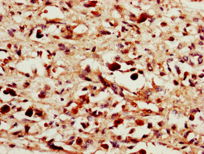 IL24 Antibody - IHC image of IL24 Antibody diluted at 1:1400 and staining in paraffin-embedded human melanoma performed on a Leica BondTM system. After dewaxing and hydration, antigen retrieval was mediated by high pressure in a citrate buffer (pH 6.0). Section was blocked with 10% normal goat serum 30min at RT. Then primary antibody (1% BSA) was incubated at 4°C overnight. The primary is detected by a biotinylated secondary antibody and visualized using an HRP conjugated SP system.